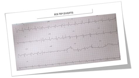 Patrón S1Q3T3 Cardioprimaria Ferrol