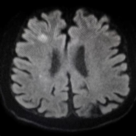 Subacute Ischemia Areas In The Right Centrum Semiovale In The Magnetic Download Scientific