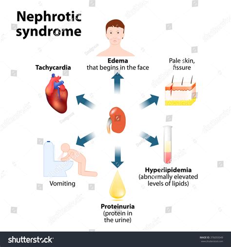 147 Nephrotic Syndrome Images Stock Photos And Vectors Shutterstock