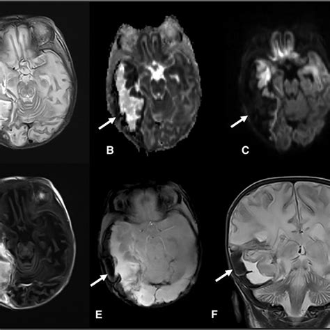 (PDF) MRI Findings in Pediatric Abusive Head Trauma: A Review