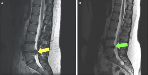 Slipped Disc And Back Pain Explained Physio Clinic London