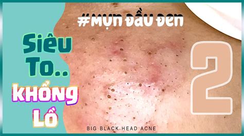 Big Cystic Acne Blackheads Extraction Blackheads Milia Whiteheads