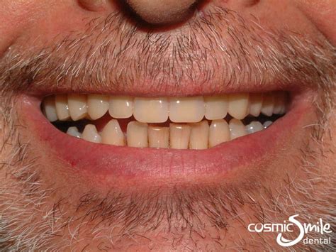 Dentures - Before and After - Cosmic Smile Dental