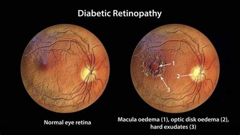 Retinoscopia Free Stock Photos Images And Pictures Of Retinoscopia