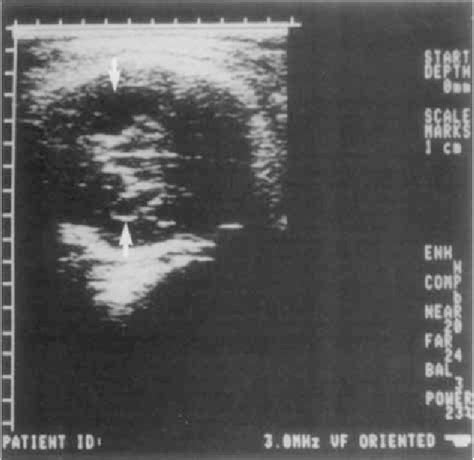 Figure 1 From Prenatal Sonographic Of Corpus Diagnosis Callosum Of