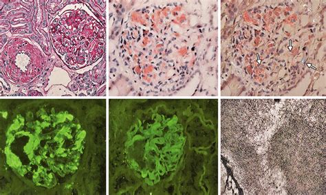 A To F A Renal Biopsy Showing Light Microscopy Findings In Al