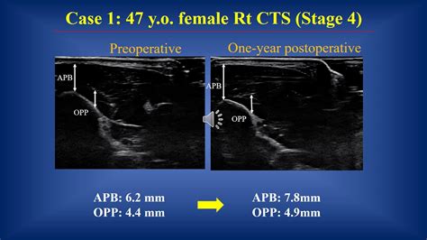 Assessment Of Recovery Of Thenar Atrophy In Carpal Tunnel Syndrome By Ultrasonography Youtube