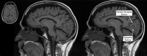 Radiological Anatomy Parieto Occipital Sulcus Stepwards