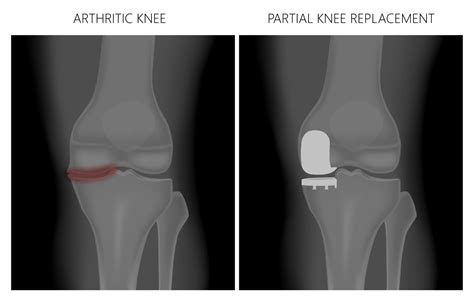 How Are Total And Partial Knee Replacements Different