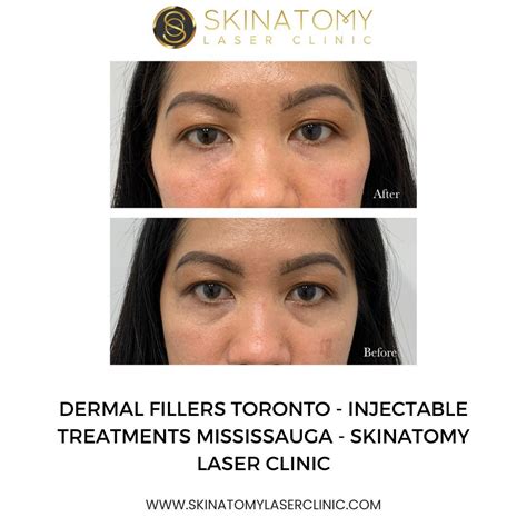 Dermal Fillers Artofit