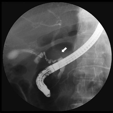 Ercp Showed A 15 Mm Long Stenosis Of The Middle Bile Duct Arrow And A Download Scientific