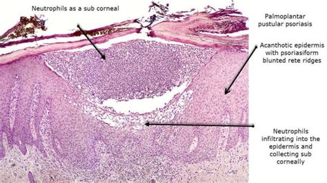 Recent Advances In The Pathophysiology Of Psoriasis Ppt