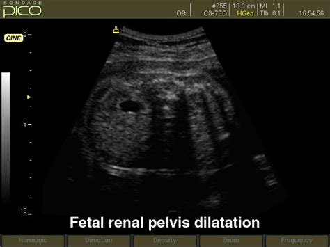 Ultrasound Images Fetal Renal Pelvis Dilatation B Mode Echogramm №261