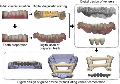 A Digital Guide Device To Facilitate Cad Cam Veneer Cementation For