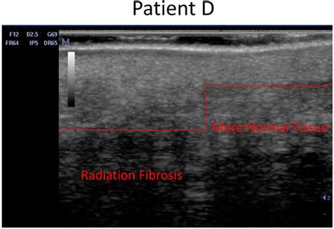 Ultrasound Image Showing Radiation Fibrosis On Patient Ds Back