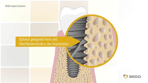 Was ist ein Zahnimplantat Ein Erklärvideo für Patienten von BEGO