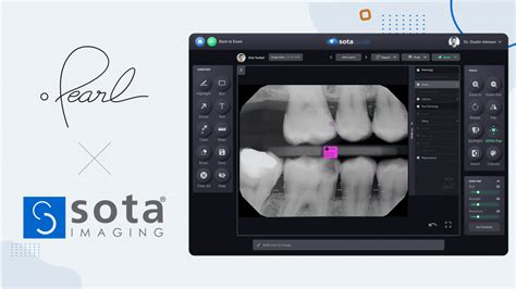 Sota Clouds Dental Imaging Software Gets Pearls Ai Pathology Detection Capabilities Sota Imaging