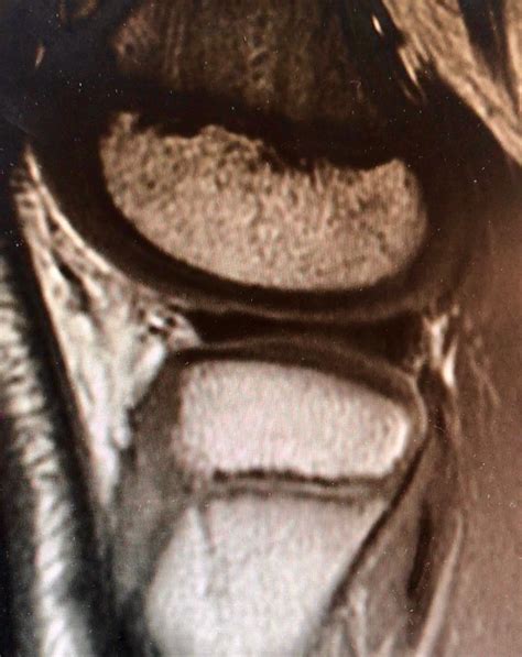 Discoid Lateral Meniscus - JR Rudzki, MD