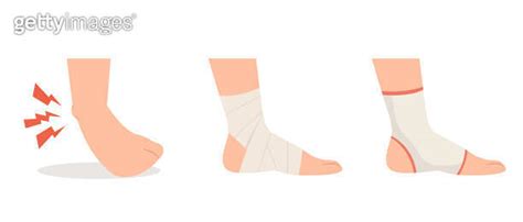 Sprained Ankle Foot With Elastic Bandage And Ankle Support Treatments 이미지 1817931349 게티이미지뱅크