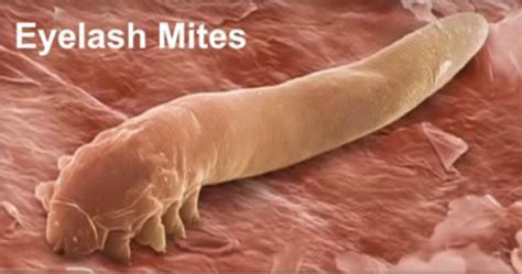 How To Detect And Eliminate Eyelash Mites Demodex Mites Eyelash