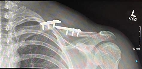 Revision Clavicle Fracture Orif With Bone Graft From The Distal