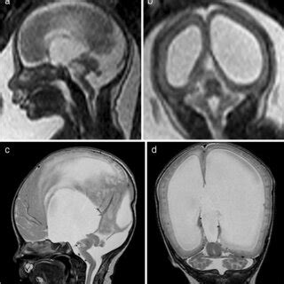 Lissencephaly type 1. a In this male fetus, MRI was performed at ...