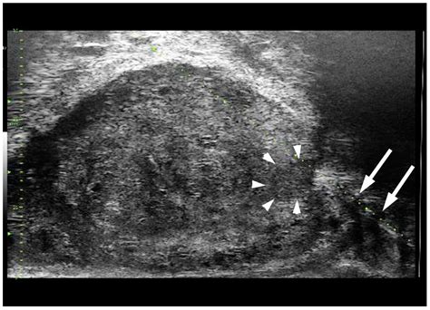 Cancers Free Full Text Micro Ultrasound Current Role In Prostate