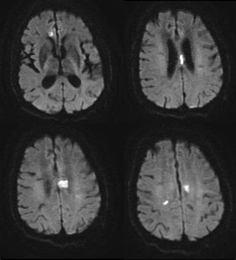 HIV Vasculopathy Versus VZV Vasculitis In An HIV Patient With Multiple