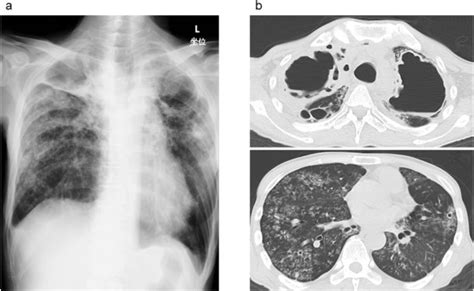 Prolonged Paradoxical Reaction Requiring Over 5 Years Of Corticosteroid