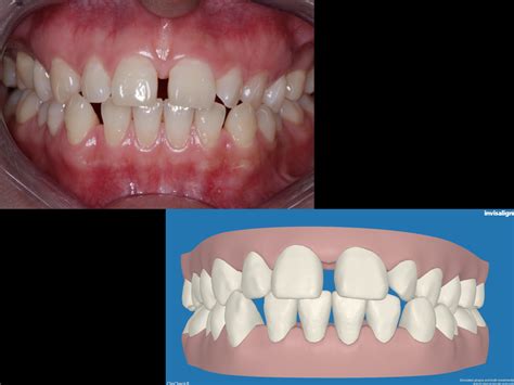 Invisalign Liverpool Azure Dental Clinic