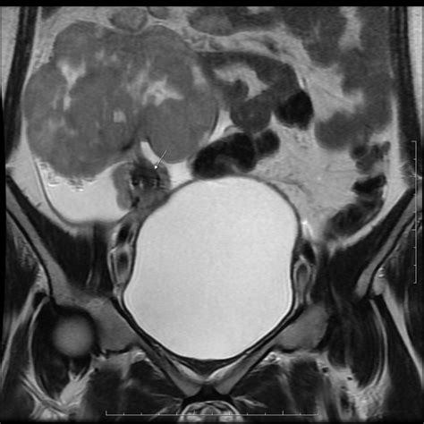 Ovarian Dysgerminoma With Torsion Eurorad