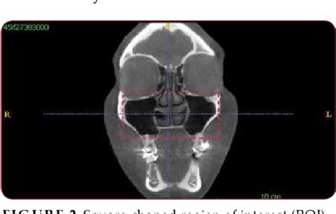 Figure From The Changes In Upper Airway Volume After Orthognathic