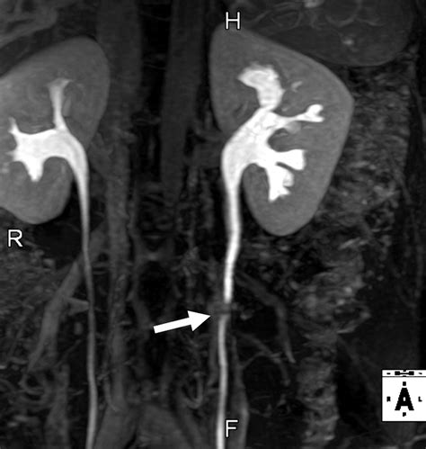 Mr Urography Techniques And Clinical Applications Radiographics