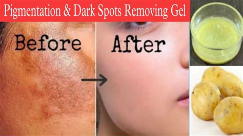 7 Days To Remove Hyper Pigmentation Dark Spots Acne Marks