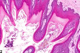 Oral Mucosa Hyperplasia Squamous Nonneoplastic Lesion Atlas