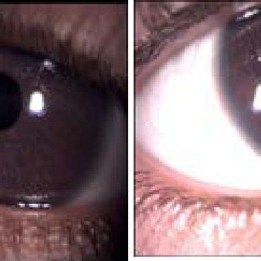 2 lisch nodules were present in each eye | Download Scientific Diagram