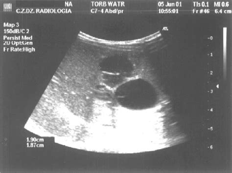 Choledochal Cyst In Abdominal Ultrasonography Download Scientific Diagram