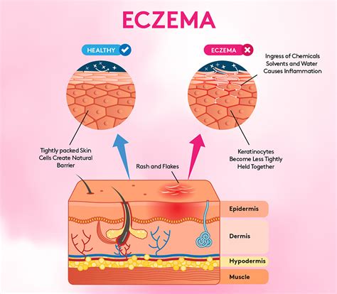 Eczema Charts