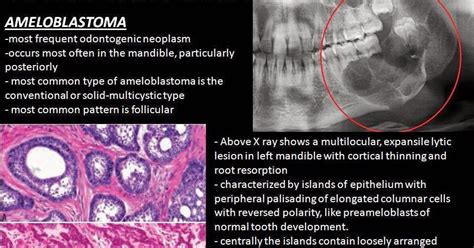 Ameloblastoma Radio Path Series Sumers Radiology Blog