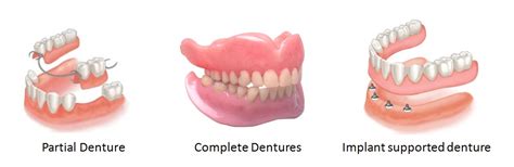 Types of Dentures: Complete, Partial and Semi-Precision Dental Implants | | Clinique Prothèse ...