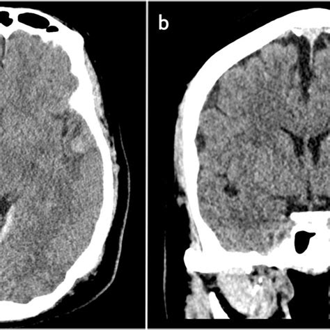 Multisequential Multiplanar Mri Images Of The Brain Including Axial And