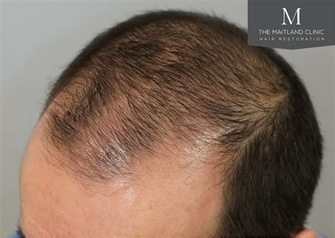 Hair Thinning Treatments Causes And Solutions