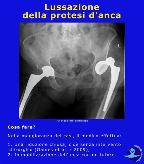 Intervento Di Protesi D Anca Durata E Complicanze Precoci E Tardive