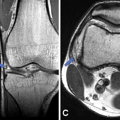 A Illustration Of Lateral Extra Articular Tenodesis Using The