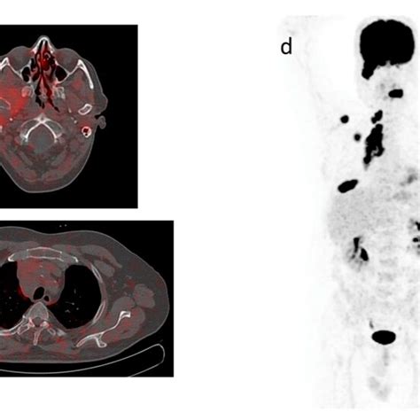 MIP views and transaxial fusion images of ⁶⁸Ga DOTATOC PET CT scans