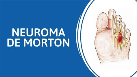 NEUROMA DE MORTON O que é Causas sintomas diagnóstico e tratamento