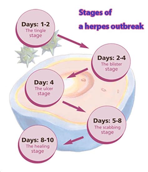 Stages Of Genital Herpes What You Should Know About Herpes Outbreak