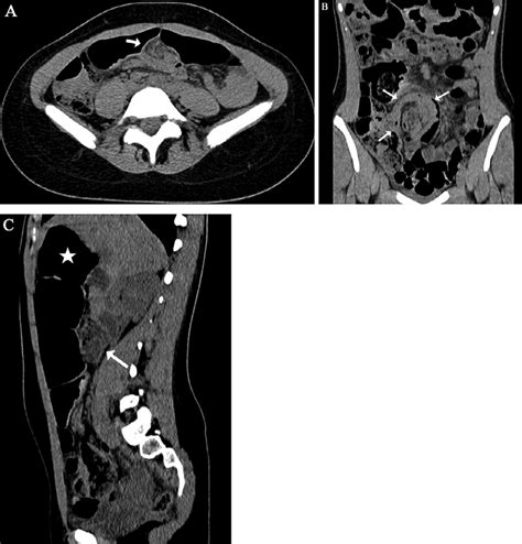 A Ct Axial View Shows The Whirlpool Sign Arrow Representing