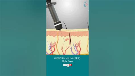 પ્લેટલેટ રિચ પ્લાઝ્મા Prp ↪ 3d Medical Animation Shorts Prp Hair