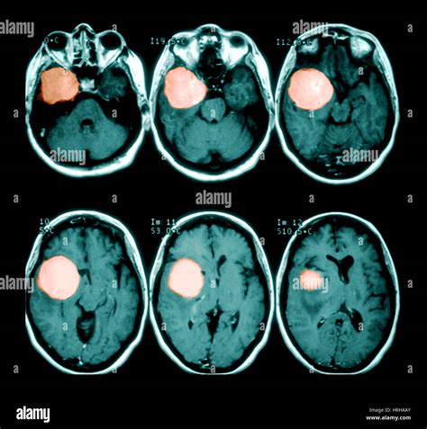 Mri Di Tumore Al Cervello Extra Assiale Immagini E Fotografie Stock Ad